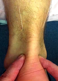 Medical Acupuncture